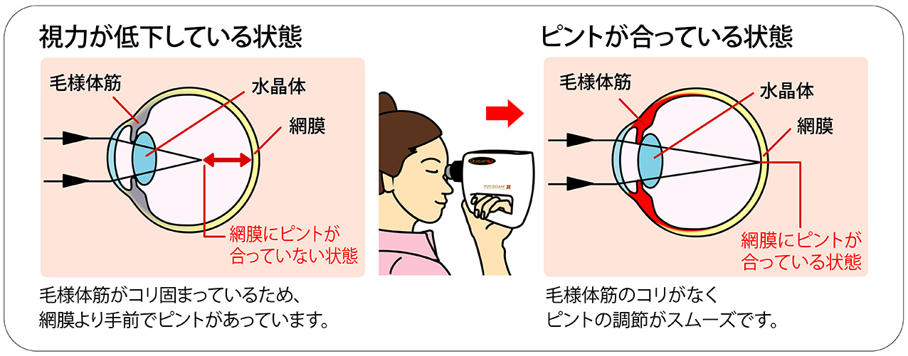 ドクターハーツを投射すると毛様体のコリがゆるむ。