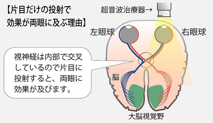 ドクターハーツは、片目だけの投射で、超音波効果は、両目におよぶ。