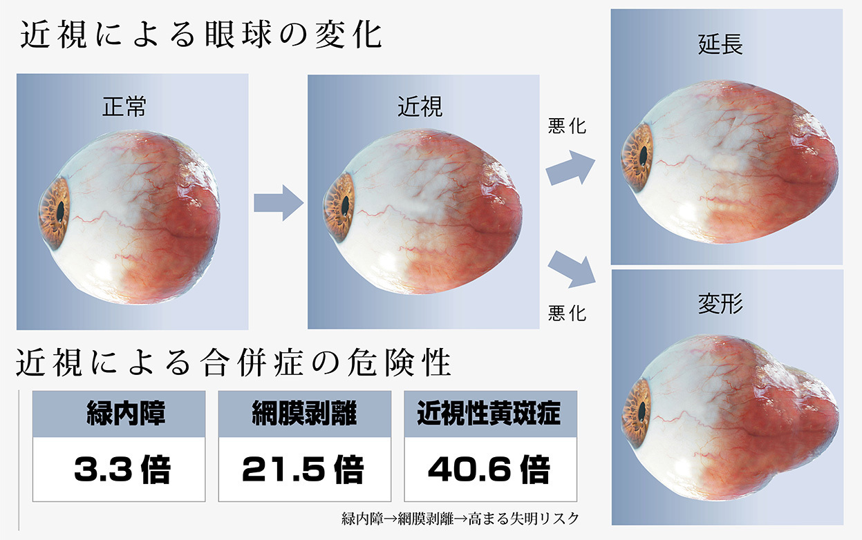 近視の度が進むほど、目の障害や失明に至る危険度が増すことになる。