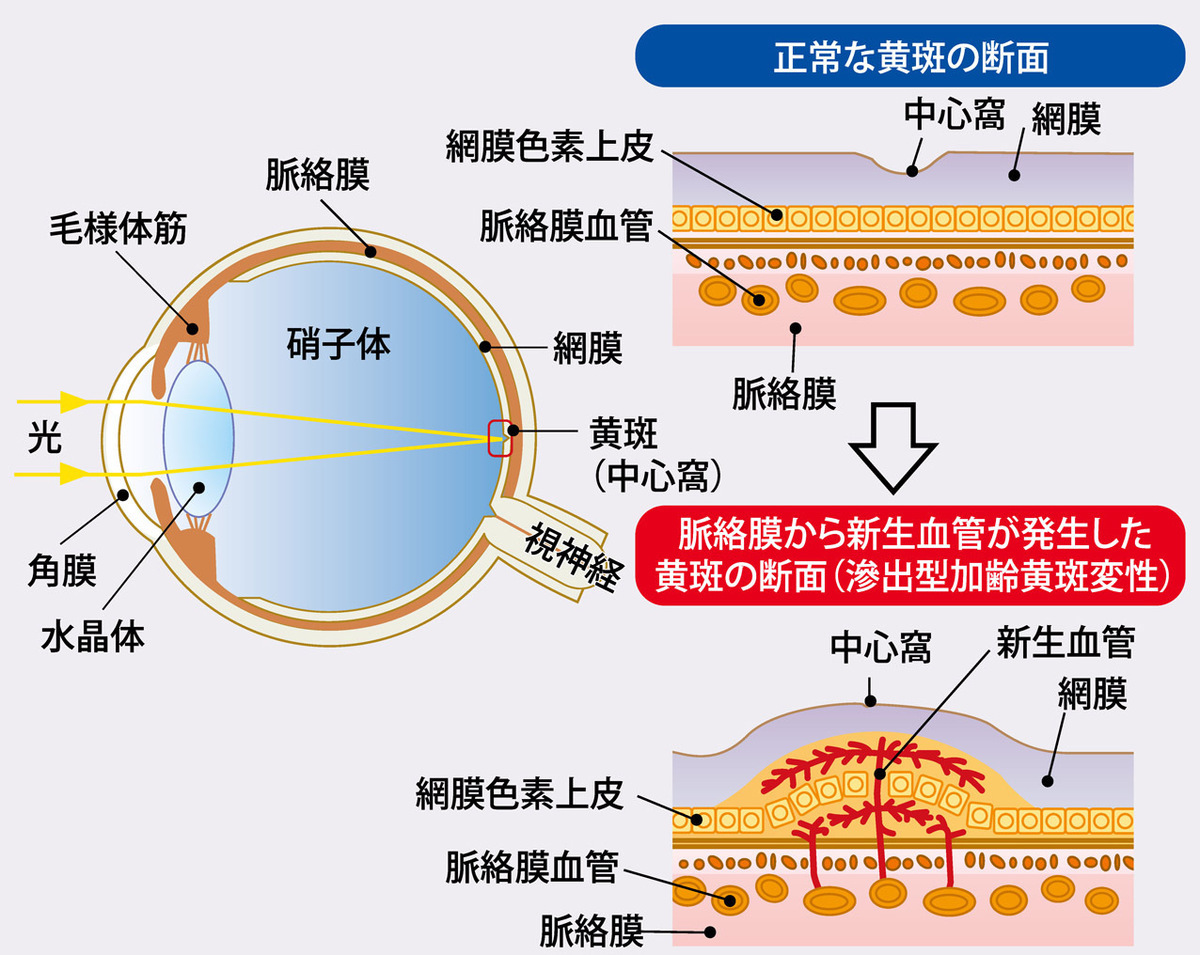 加齢黄斑変性_中高年の目の病気③