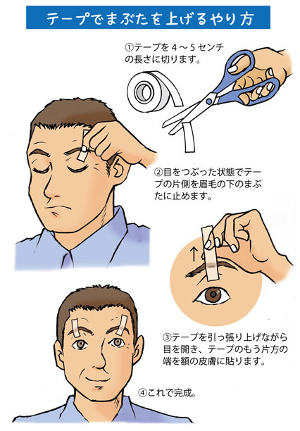 まぶたのたるみの原因、眼瞼下垂（がんけんかすい）とは