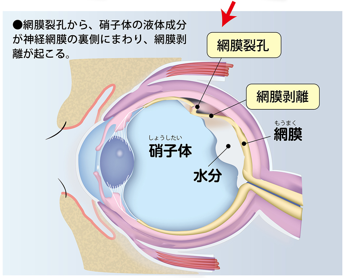 網膜剥離は失明につながるだけに、その初期症状を見逃さないことが大切