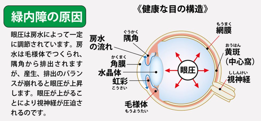 イラストで詳細に解説。緑内障とは!