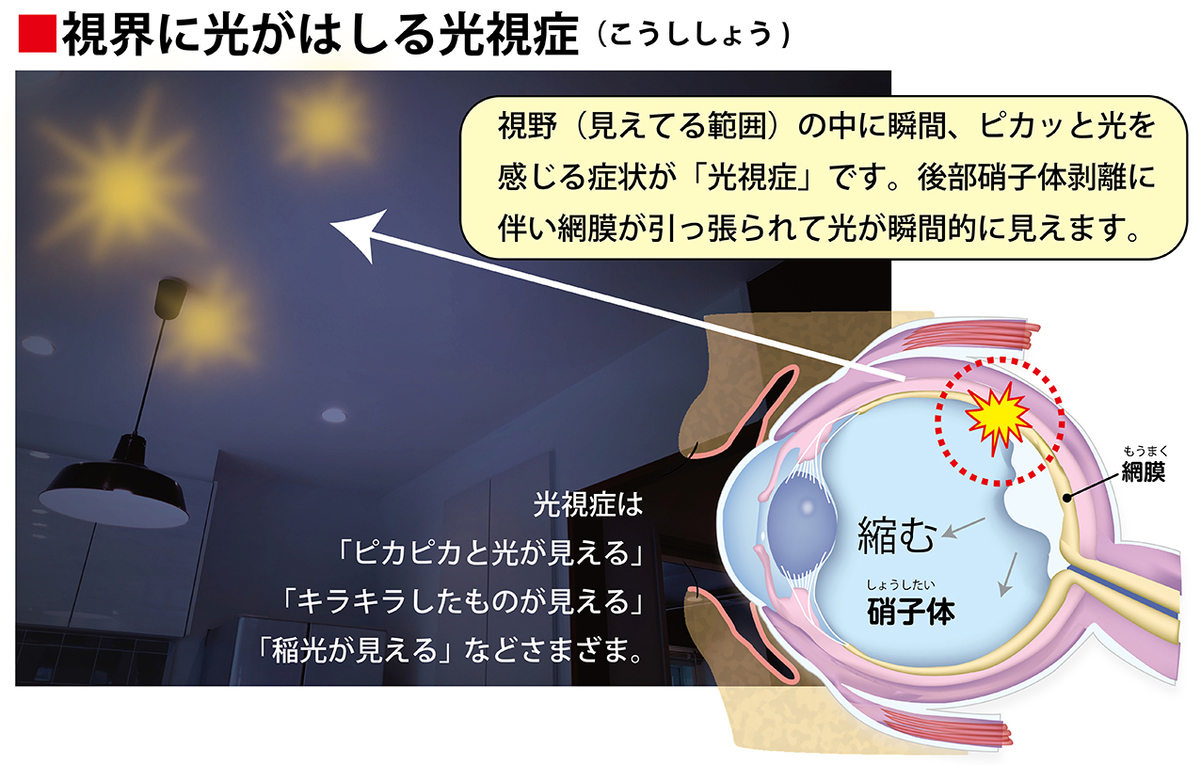 網膜剥離は失明につながるだけに、その初期症状を見逃さないことが大切