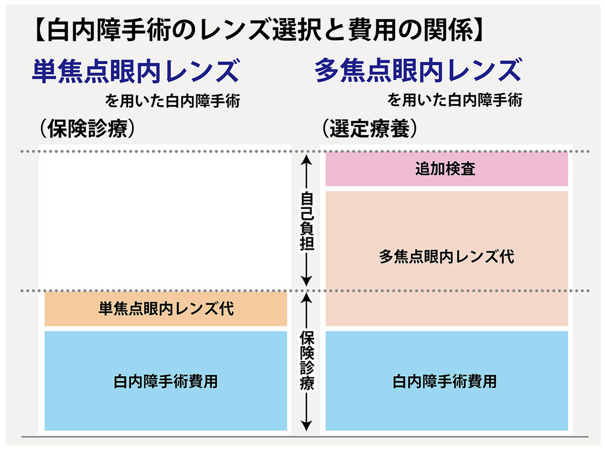 中高年の目の病気 ①　白内障と白内障手術