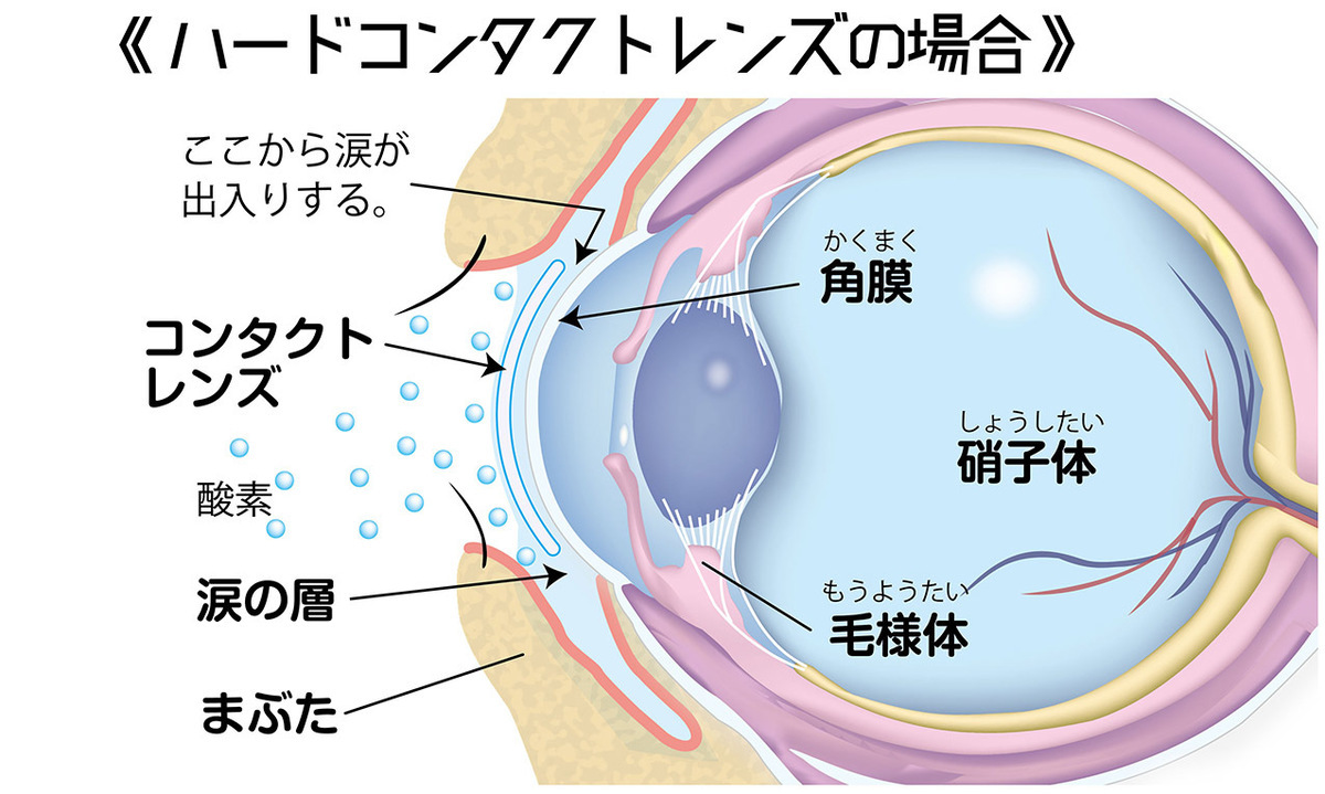 知識不足が目の障害を招く、コンタクトレンズ。