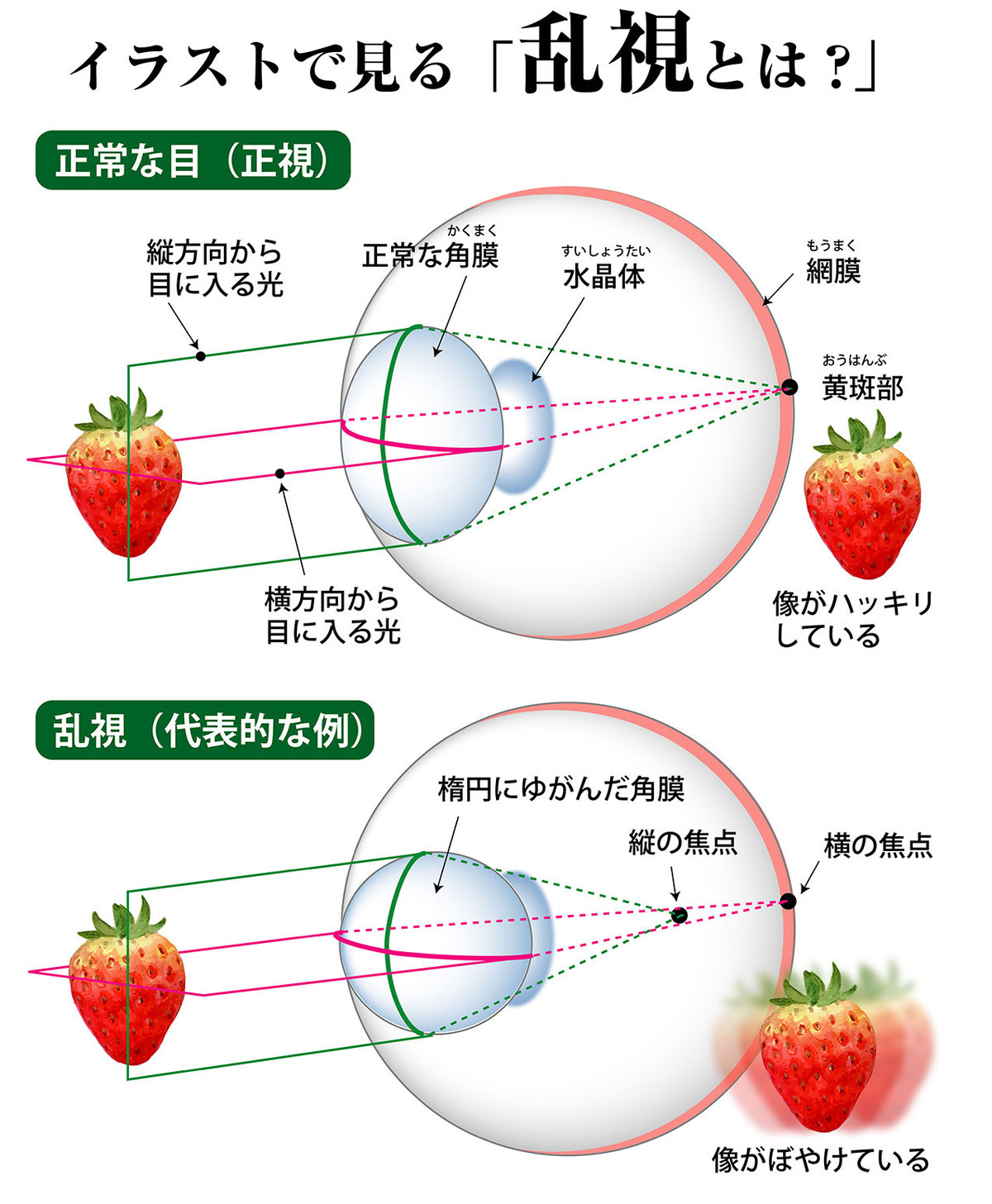 イラストで詳細に解説。乱視とは?