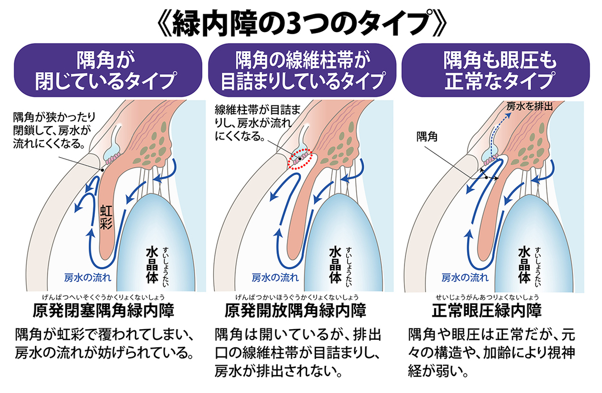 眼圧の上昇で視野が狭まる目の病気【緑内障】