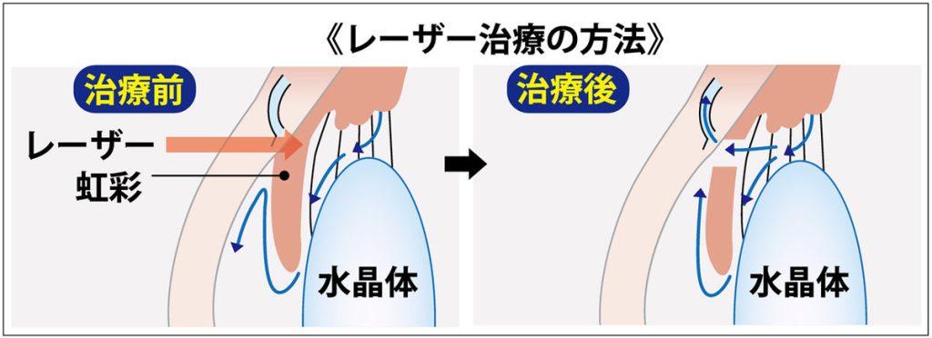 イラストで詳細に解説。緑内障とは!