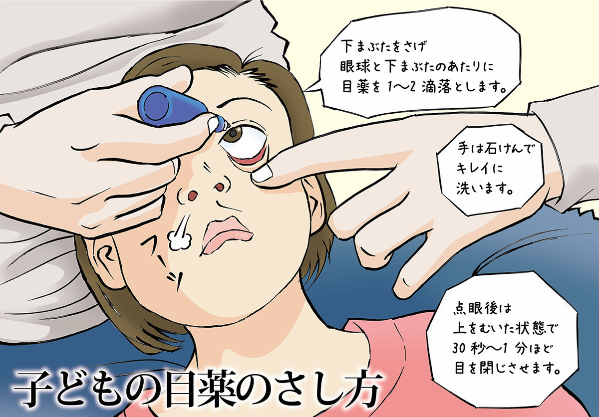 子どもへの目薬の上手なさし方をイラストで紹介