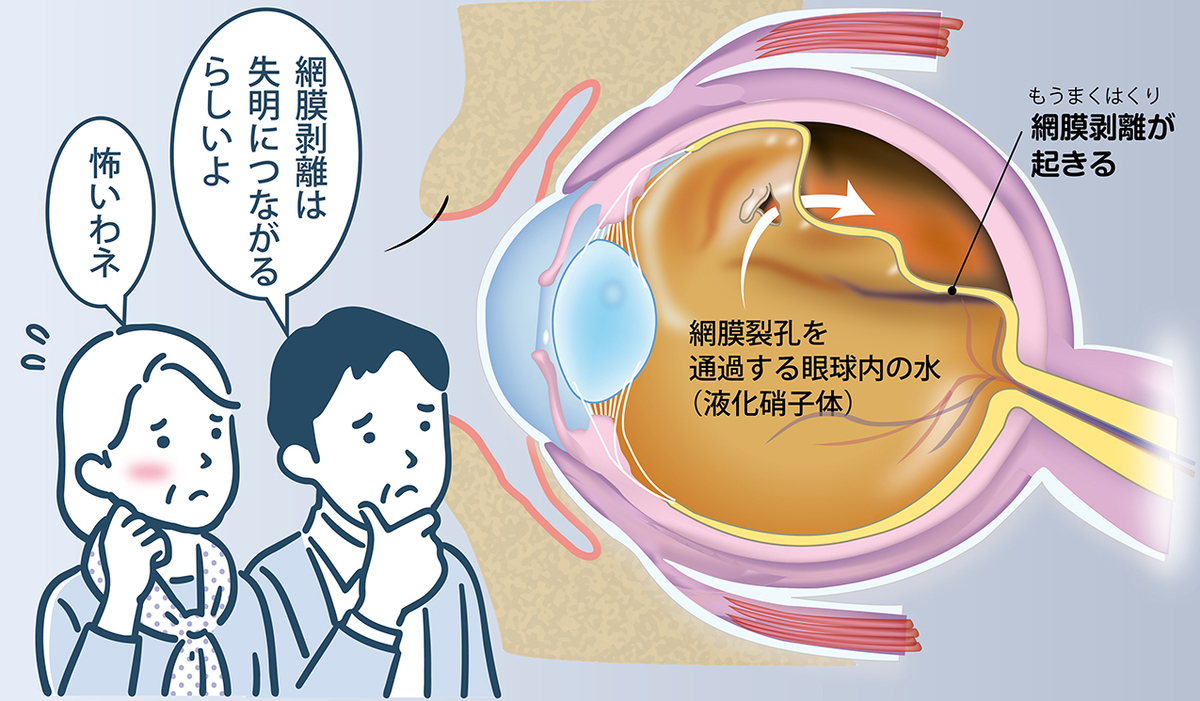 網膜剥離は失明につながるだけに、その初期症状を見逃さないことが大切