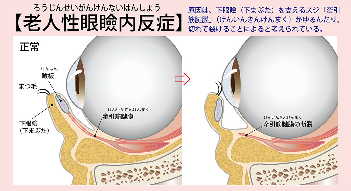 逆さまつげの症状と治療法