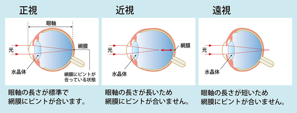 子供の目のトラブル…　正視・近視・遠視