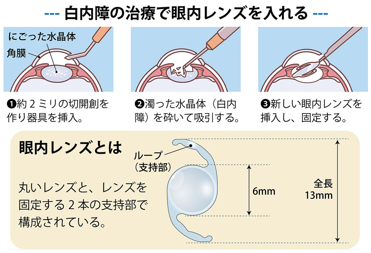 白内障手術は認知症の発症リスクを最大30％減らす。