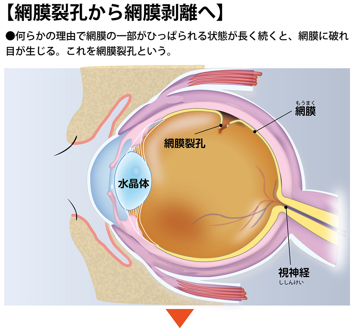 網膜剥離は失明につながるだけに、その初期症状を見逃さないことが大切