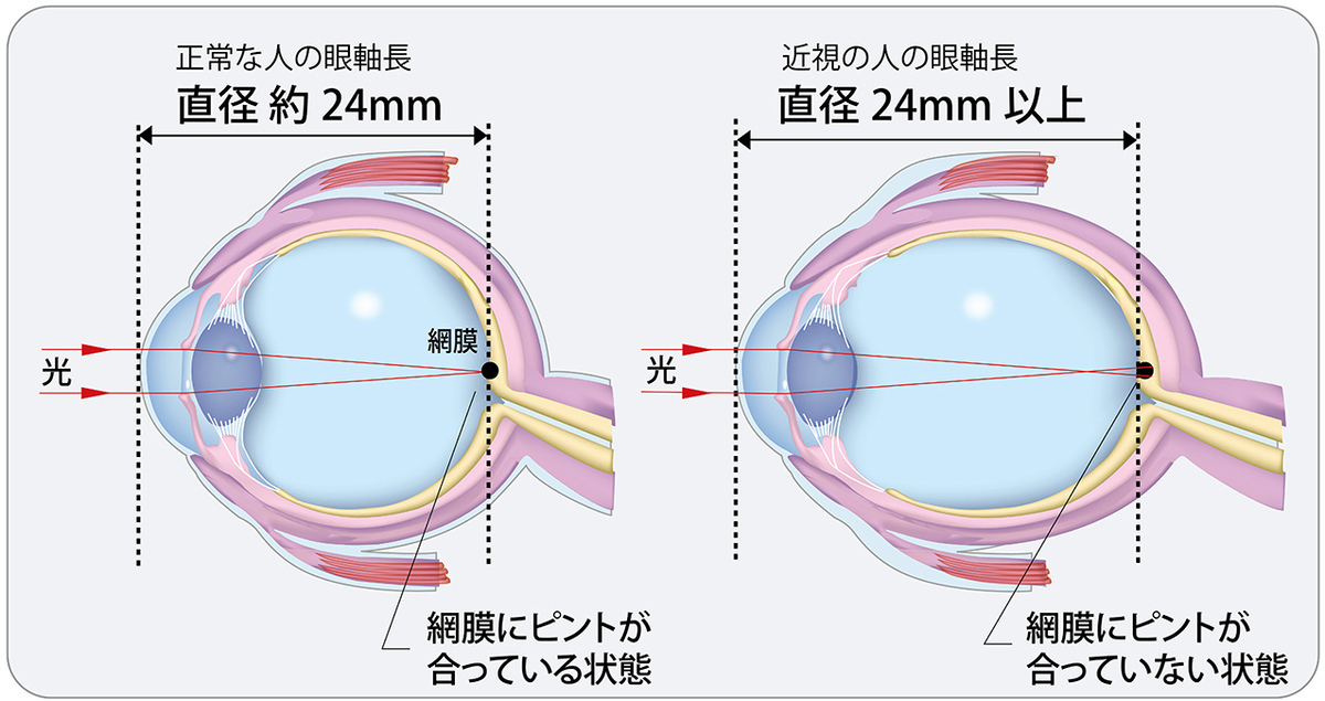 文部科学省で2021年度「児童生徒の近視実態調査」結果を発表。