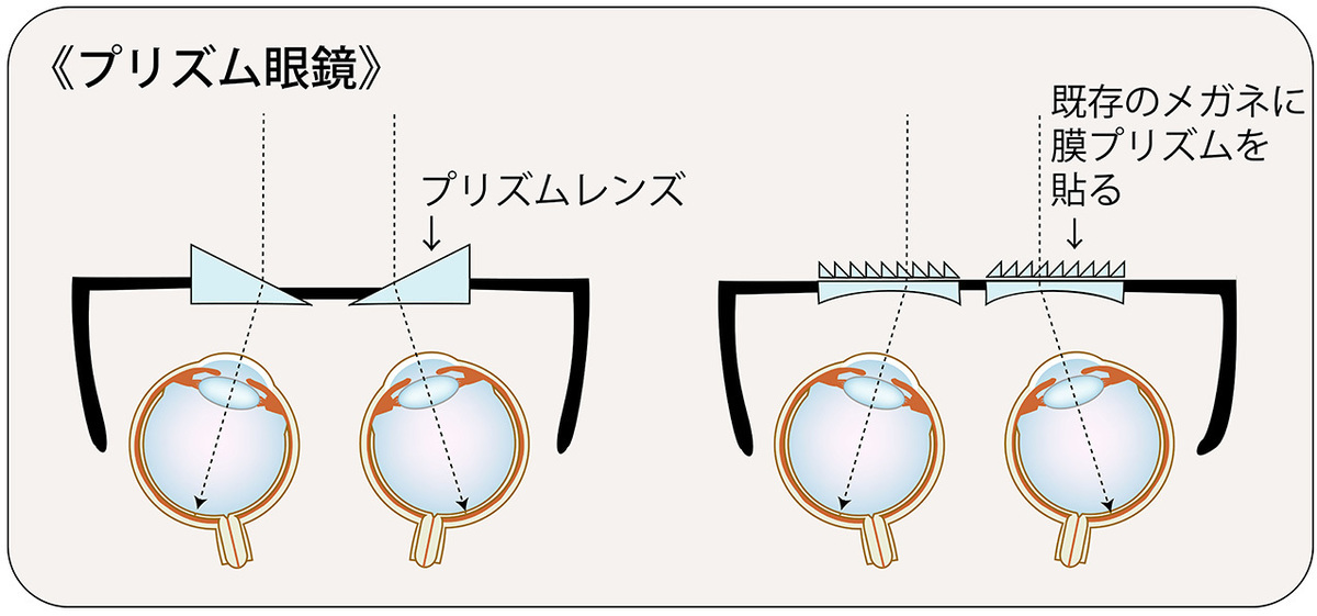 ものが「二重」に見えたら「サギングアイ症候群」かも。