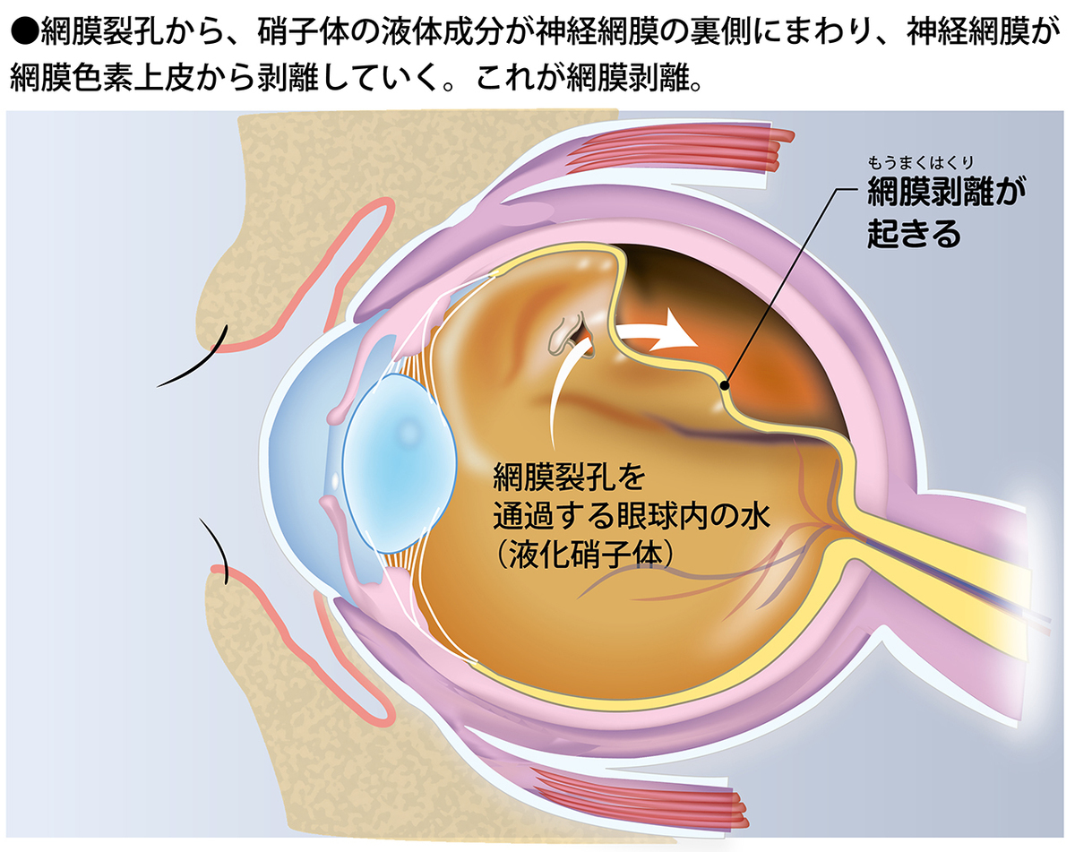 網膜剥離は失明につながるだけに、その初期症状を見逃さないことが大切