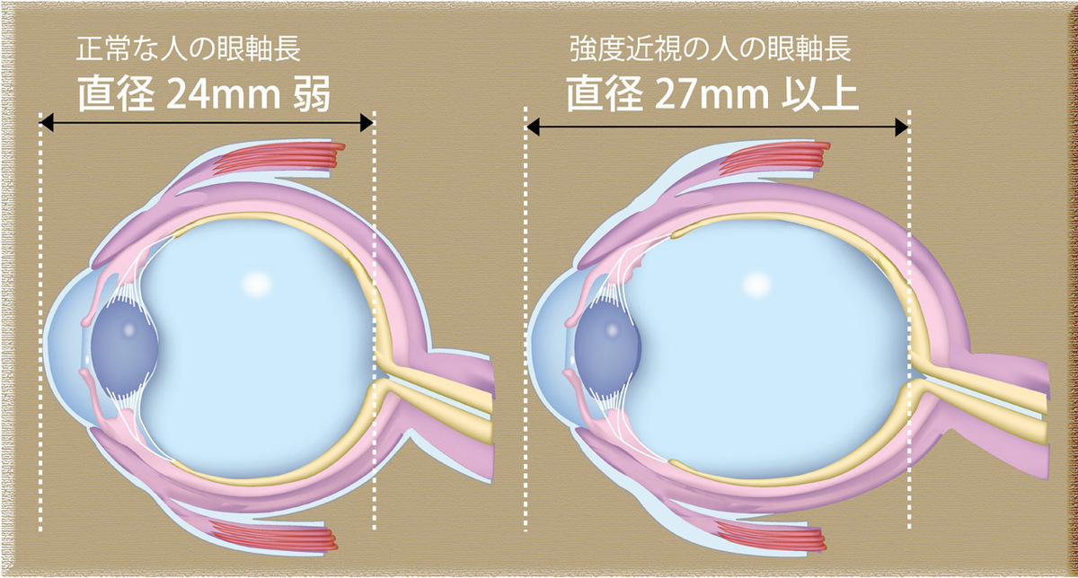 太陽の光を浴びると近視が防げる