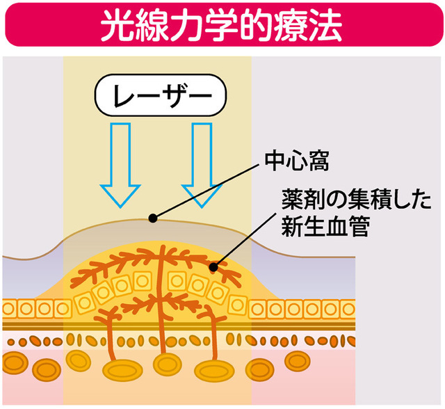 加齢黄斑変性_中高年の目の病気③