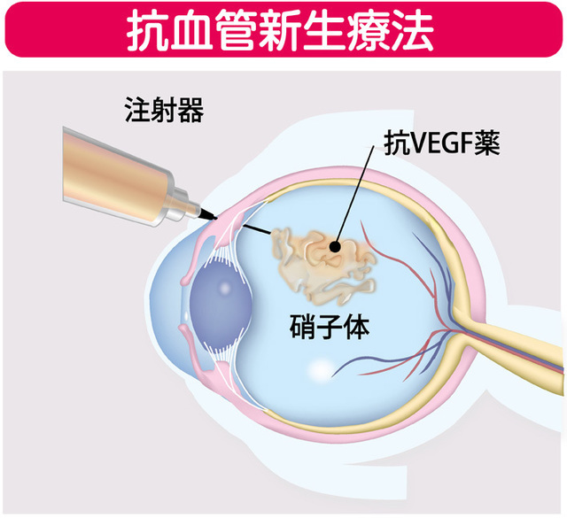 加齢黄斑変性_中高年の目の病気③