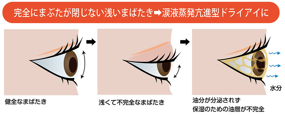 働く女性の目の悩み……対策と解消方法!