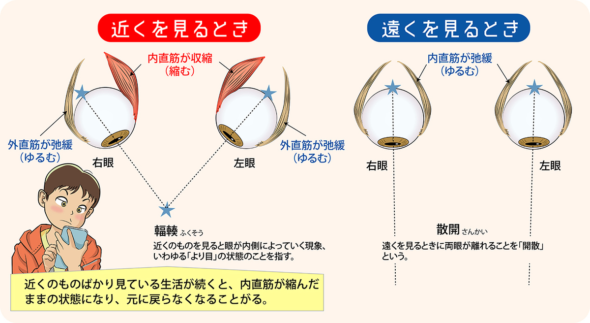 スマホの見過ぎで急性内斜視（スマホ内斜視）になる?!