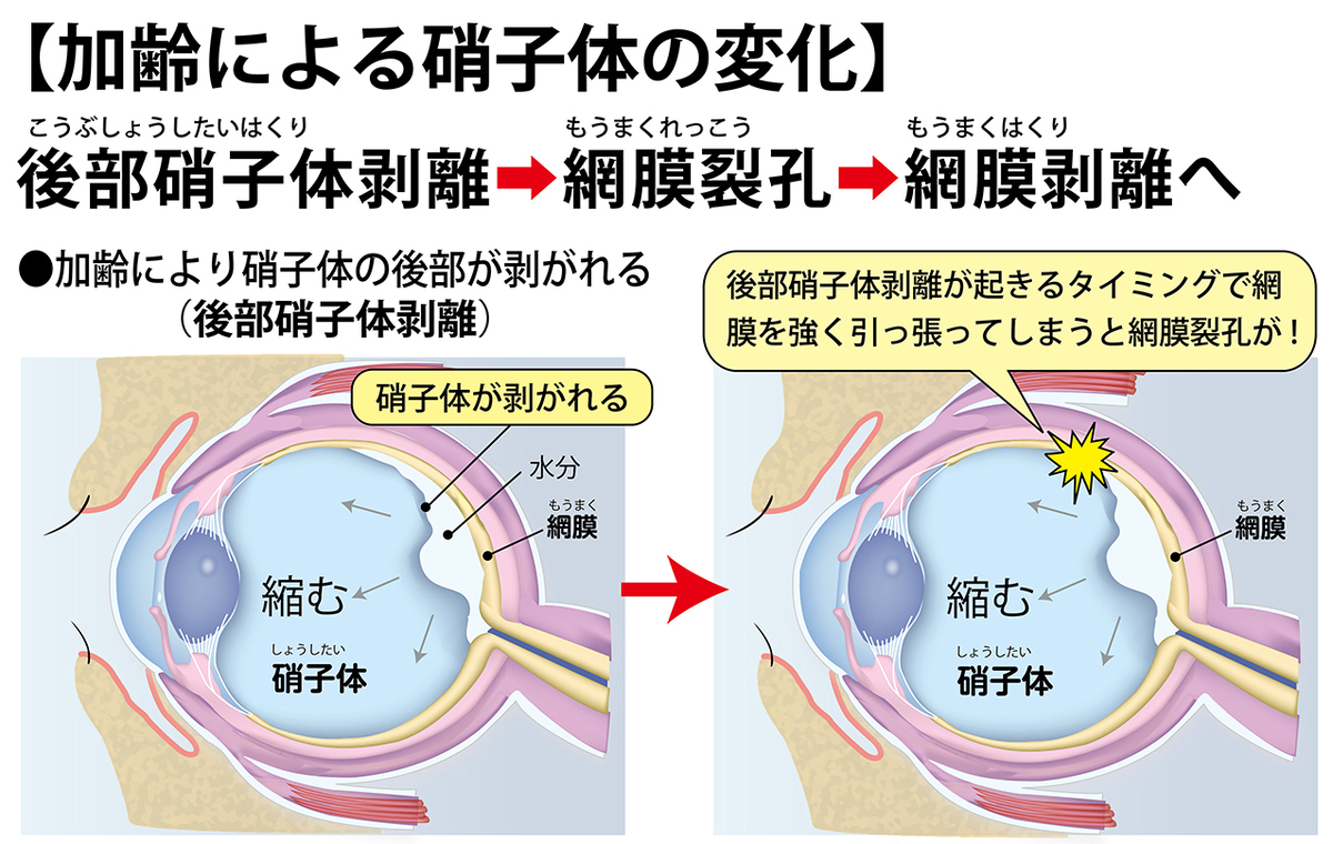 網膜剥離は失明につながるだけに、その初期症状を見逃さないことが大切