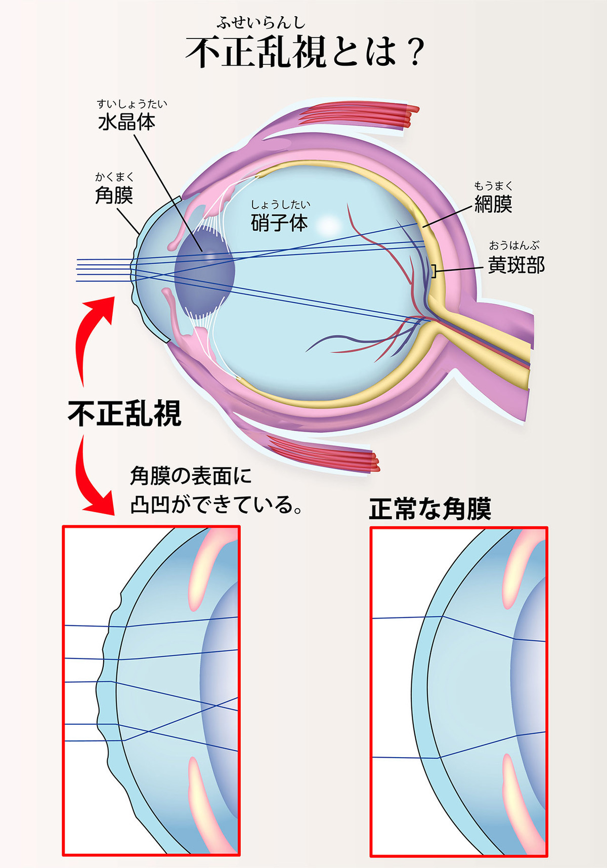 子供の目のトラブル…　正視・近視・遠視