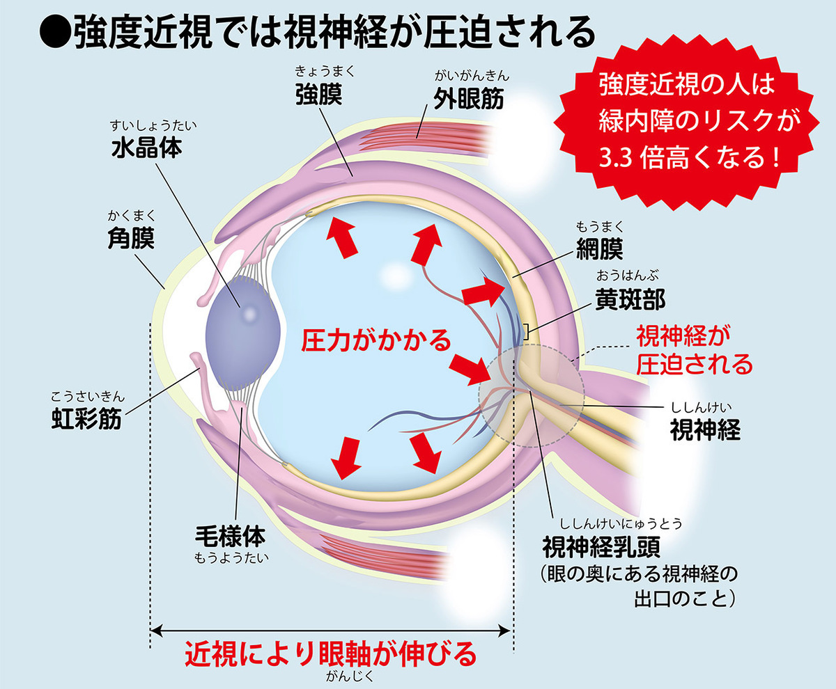 眼圧の上昇で視野が狭まる目の病気【緑内障】