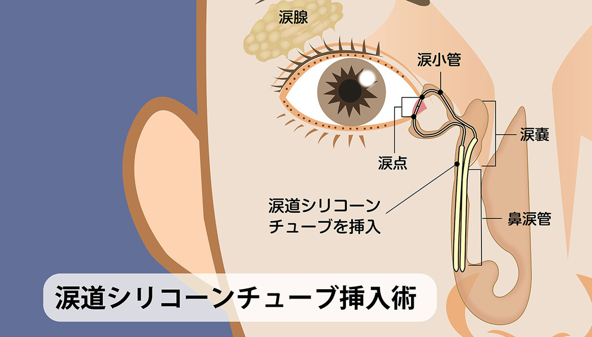 なみだ目（流涙症）の症状と対策